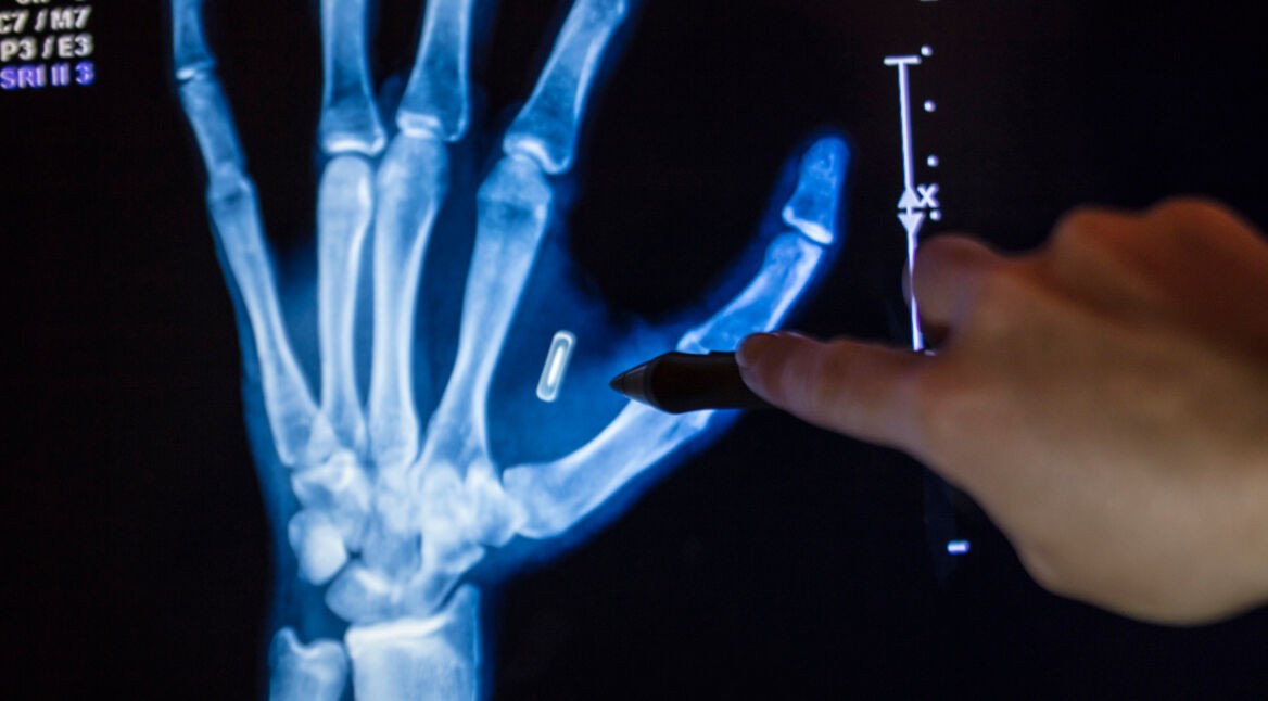 Microchip Hand Implant